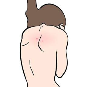 背中ニキビの管理